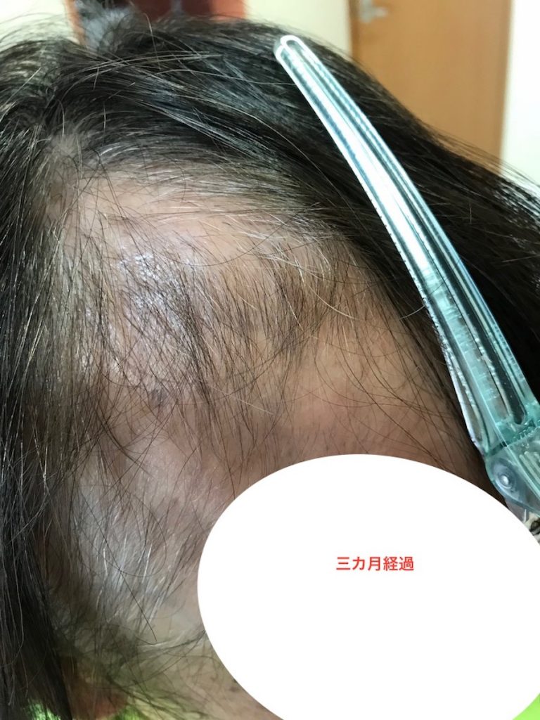 育毛三カ月経過
