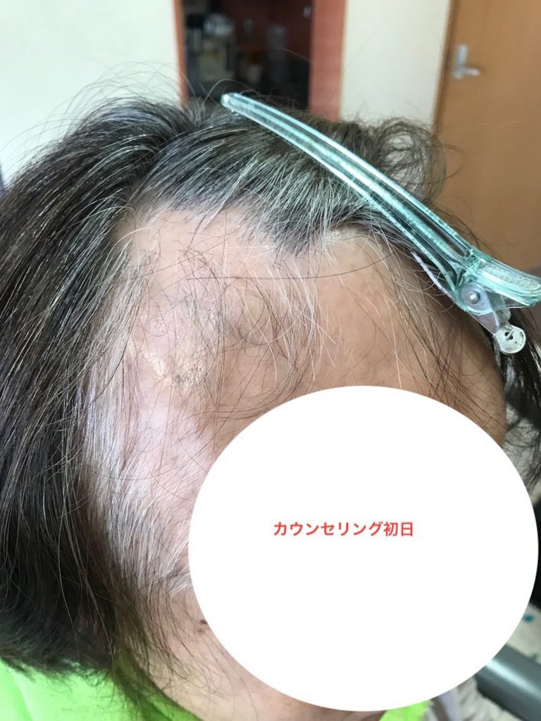 育毛カウンセリング初日